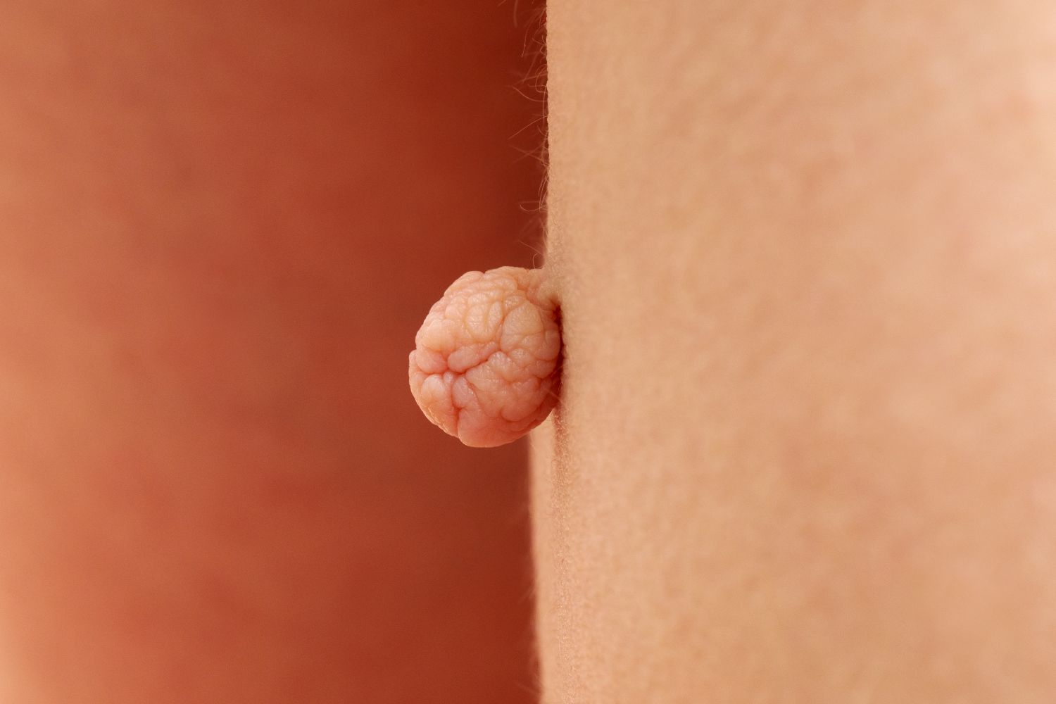 Warts